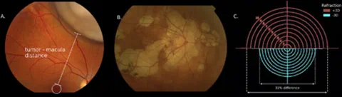 Fundus photographs illustrating an intraocular tumor and chorioretinal atrophy, with scale variation shown in phantom eyes with different refractions.
