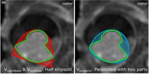 Two tumour models and MRI contours for a mushroom-shaped and a dome-shaped uveal melanoma.