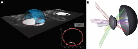 3D overlay of the segmented retinal structure on the MR-image used for patient specific ray tracing.