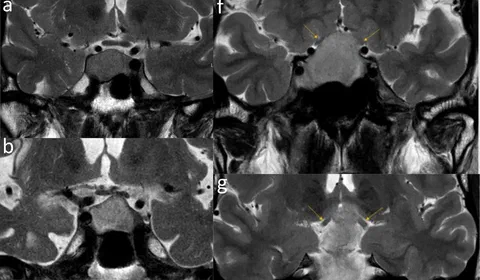 Coronal T2 weighted images showing different grades of compression on the optic system and hyperintensity of the optic nerve.