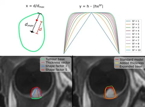 Steps to build a geometric tumor model from an MRI-delineated uveal melanoma: thickness, tumor base, shape-factor height profiles and model variations.