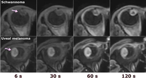 Perfusion weighted MRI data of a uveal melanoma and schwannoma.