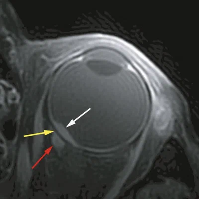Histopathological validation of uveal melanoma MRI characteristics
