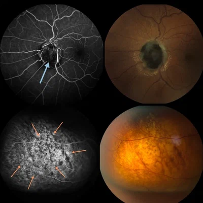 Perfusion-weighted MRI of intra-ocular masses