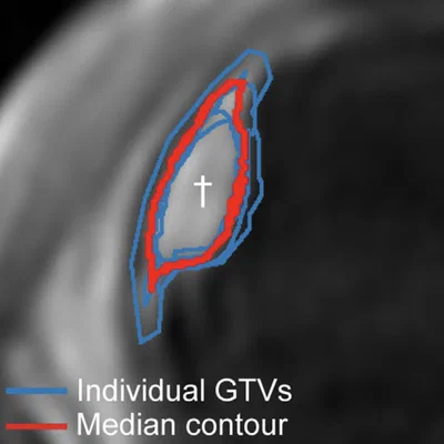 Inter-observer variability in MRI target delineation for uveal melanoma