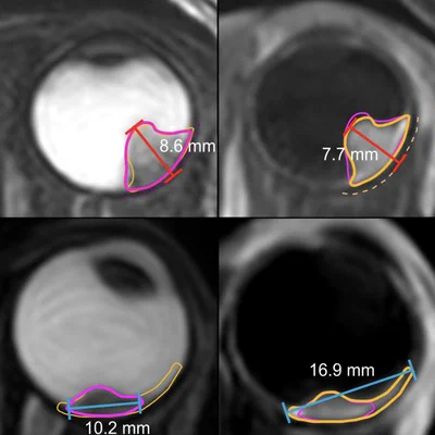 3D MRI measurements of tumour dimensions for proton therapy planning