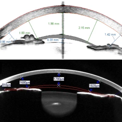 Outcomes after phakic intraocular lens removal combined with cataract surgery